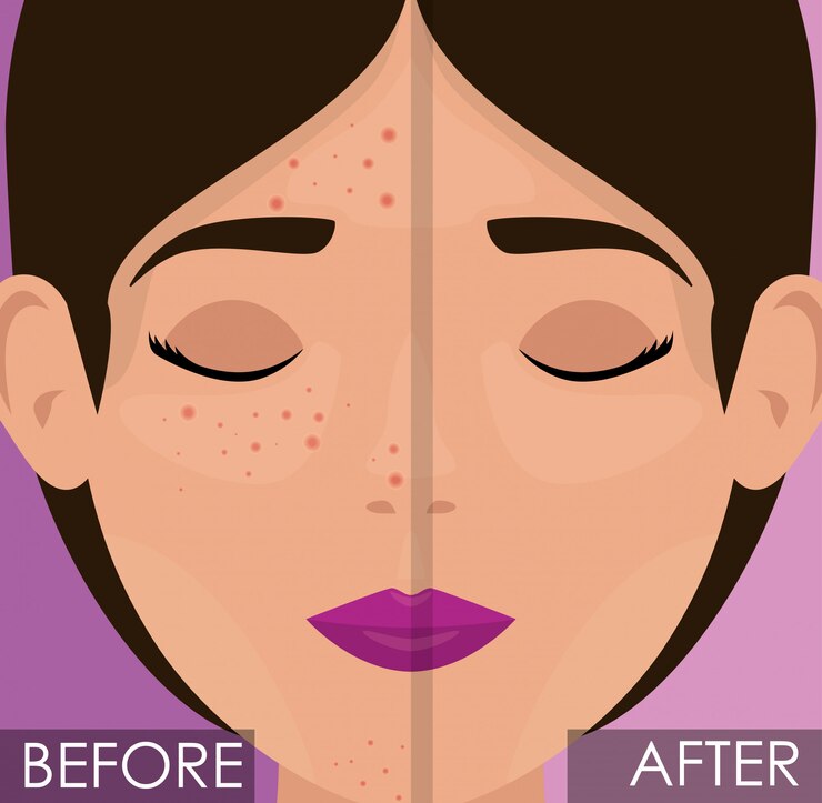 Acne scar laser treatment